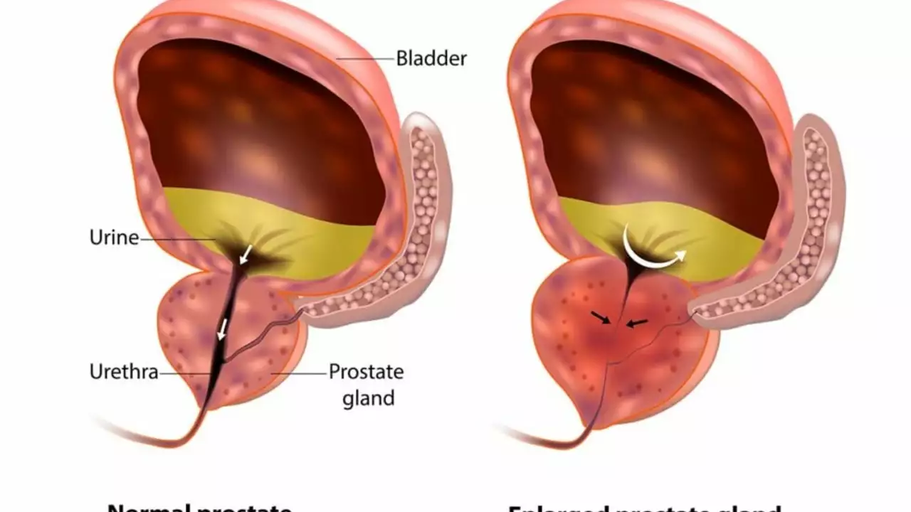 La Connessione tra l'Iperplasia Prostatica Benigna e le Infezioni del Tratto Urinario